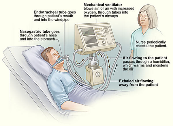 mechanical ventilator
